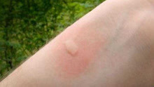 人被蚊子叮后会起个包，别着急，教你4招可以快速止痒消肿